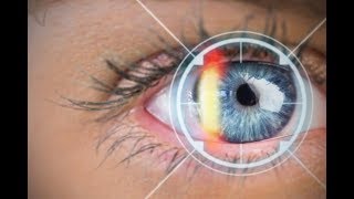 الأستيجماتيزم - إنحراف سطح القرنية - Astigmatism  ( ما هو وما أعراضه وكيف يمكن تشخيصه وعلاجه )