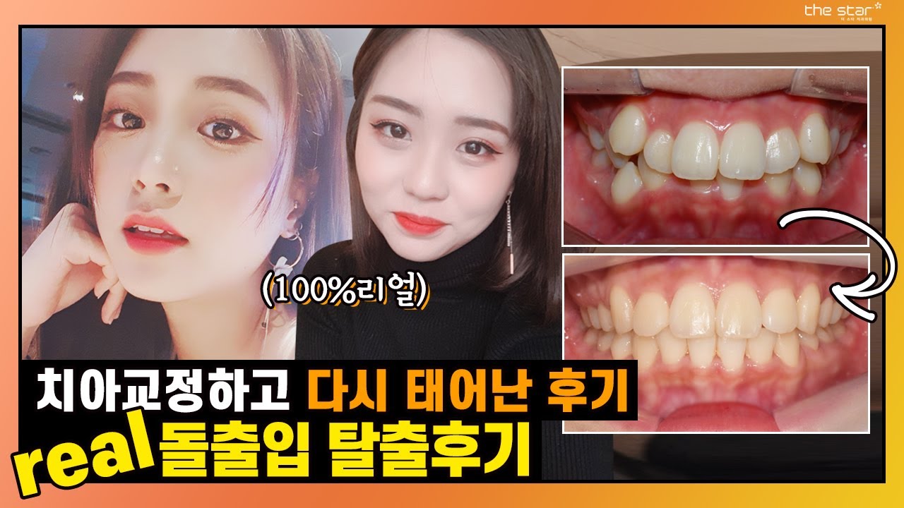 프로교정러의 2년돌출입 교정후기