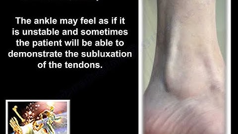 Peroneal Tendon Subluxation Briefly - Everything You Need To Know - Dr. Nabil Ebraheim