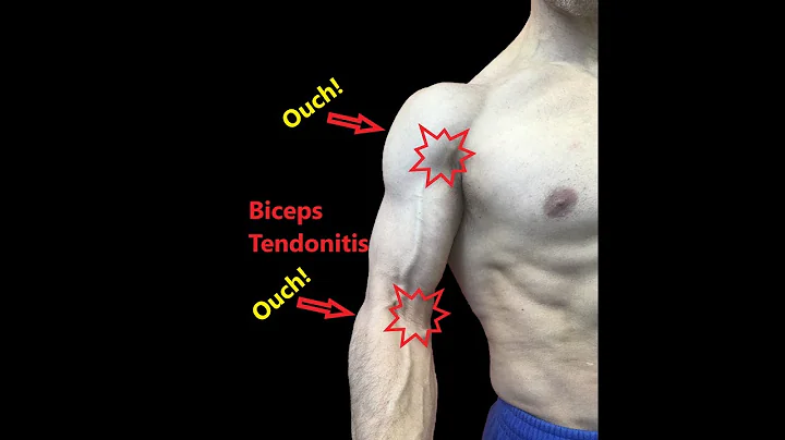 La tendinite du tendon du biceps: Étirements et relâchement fascial