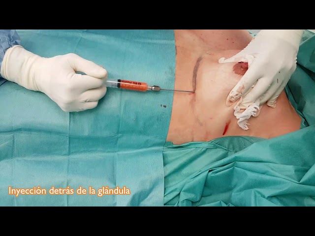 la mejor forma de reducir la grasa mamaria