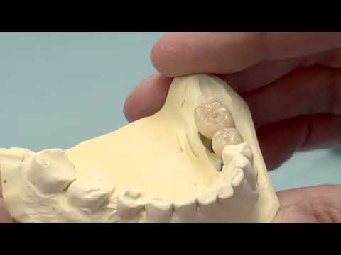 FAQ Visalys® CemCore door tandarts Rob Vermaas: Welke cementkleur heeft de voorkeur bij abutments?