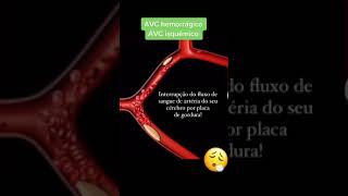 AVC isquêmico ou Hemorrágico, entenda a diferença.