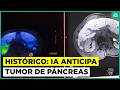 Hito en la medicina: Desarrollan inteligencia artificial que anticipa el tumor de páncreas