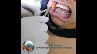 عملية إزالة دهون الخد تحت تخدير موضعي Buccal Fat Removal Under Local Anesthesia