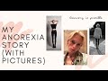 MY ANOREXIA STORY! (with pictures) | Recovering Victoriously