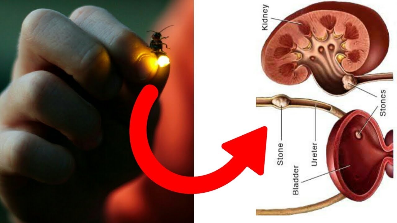 Firefly Injection Bladder Firefly (Jugnu) Best Ayurvedic Treatment For Kidney & Bladder Stone In ...