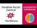 Diagnóstico Diferencial. Parálisis facial: Central vs Periférica