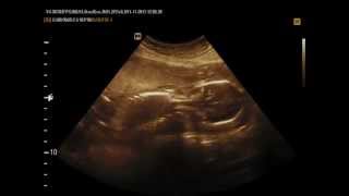 Med2000Eco Oligoidramnios - Anidramnios