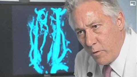 Dr. Hubbard CCSVI Interview ABC 10 - San Diego - Part 2