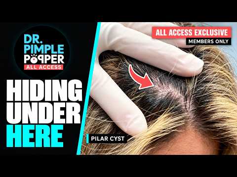 ALL ACCESS EXCLUSIVE: Hidden Pilar Cyst vs. Dr. Pimple Popper