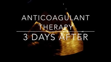 Left Atrial Appendage Thrombus