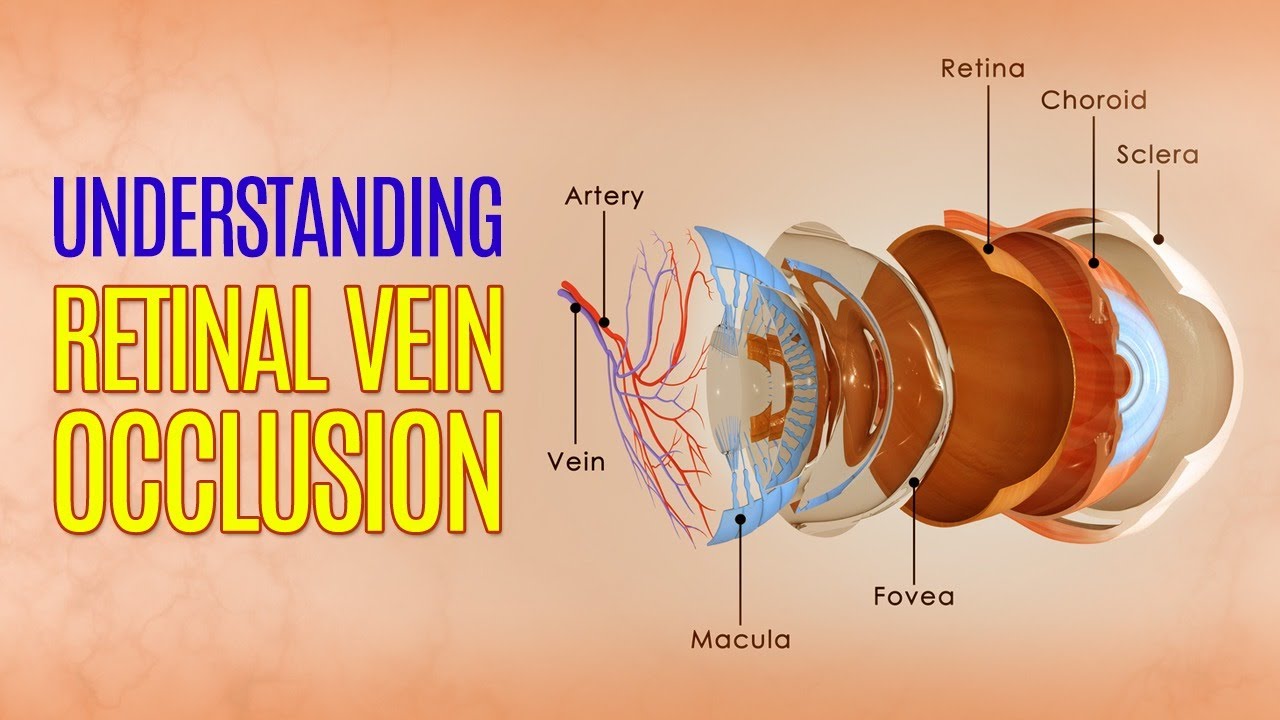 Understanding Retinal Vein Occlusion (RVO) - YouTube