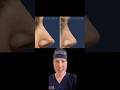 Complex Revision Rhinoplasty