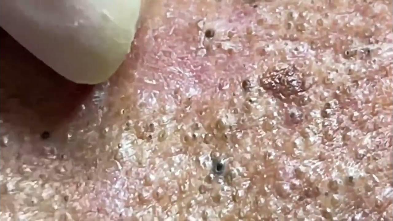 The best way to remove blackheads from an elderly youtube