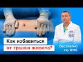 Как избавиться от грыжи живота?