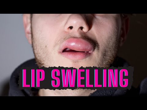 Video: Kaip išgydyti patinę lūpą: 15 žingsnių (su nuotraukomis)