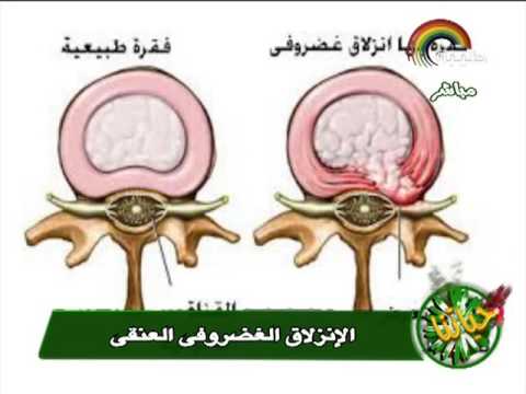 الانزلاق الغضروفى العنقى د خالد اسماعيل مدرس جراحة المخ و الاعصاب بكلية الطب