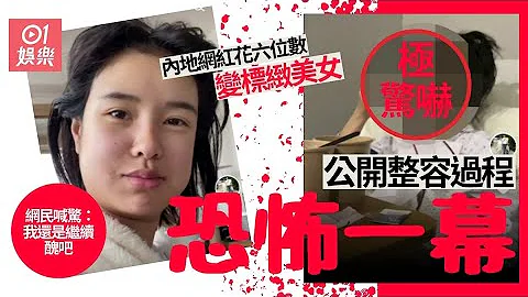 内地网红整容变大美女　公开恐怖削骨过程口插两喉管放血吓窒网民 - 天天要闻