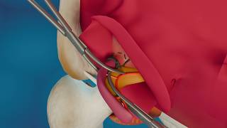 appendectomy 3D animation