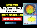 Phaco basics hydrodissection what can go wrong  intraoperative capsular block syndromepc rupture