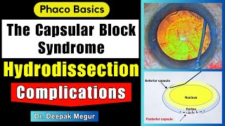 Phaco Basics Hydrodissection What Can Go Wrong? - Intraoperative Capsular Block Syndromepc Rupture