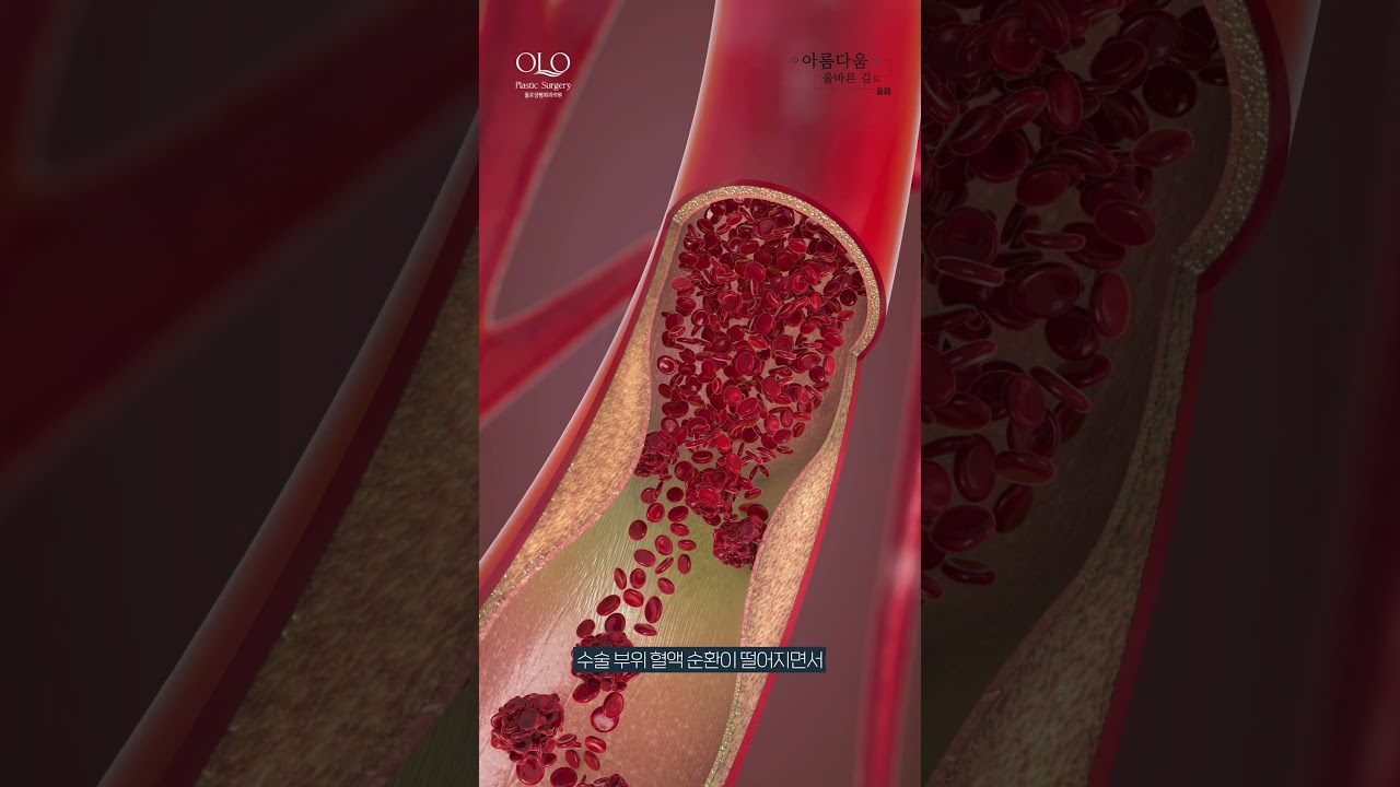 [奧露整形外科診所] 整形手術後，喝酒抽菸，何者更危險？