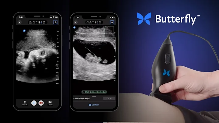 OB/GYN Ultrasound | Butterfly Network