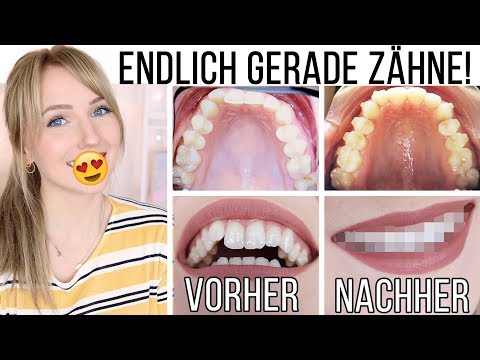 VORHER/NACHHER: SO sehen meine Zähne JETZT aus! Meine Erfahrung mit Invisalign! TheBeauty2go