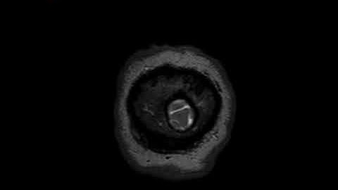 Multiparametric MRI in 52 years old patient with large brain tumor
