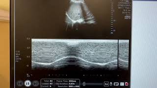 Ultrasound to Assess Diaphragmatic Paralysis –Supplementary Video [454708]