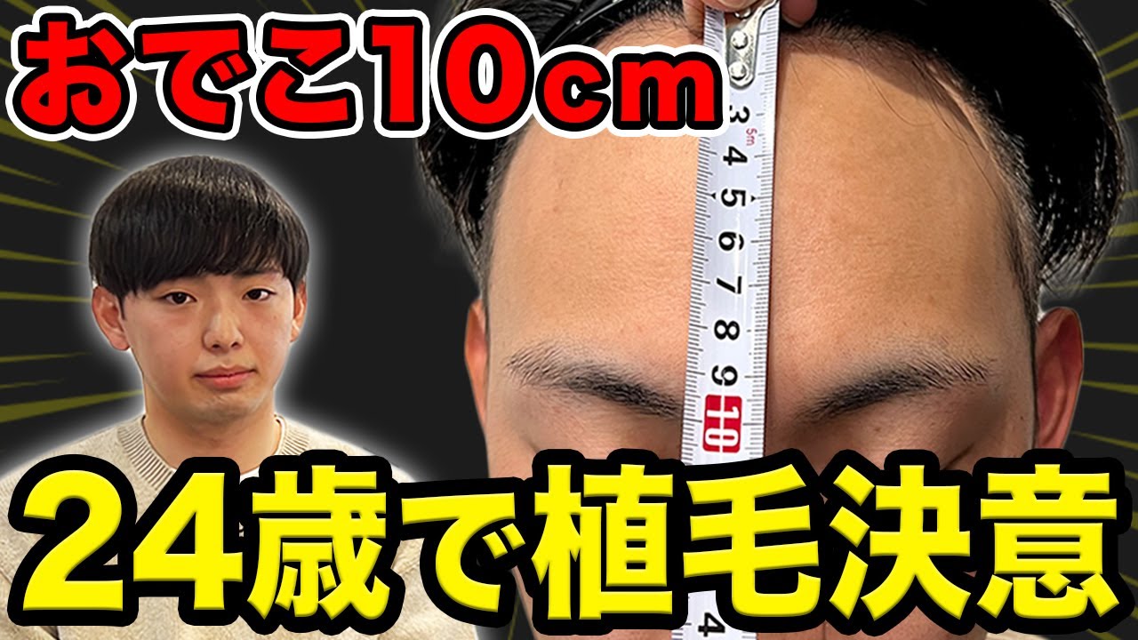 植毛密着 24歳が植毛手術で広いおでこを治す Youtube