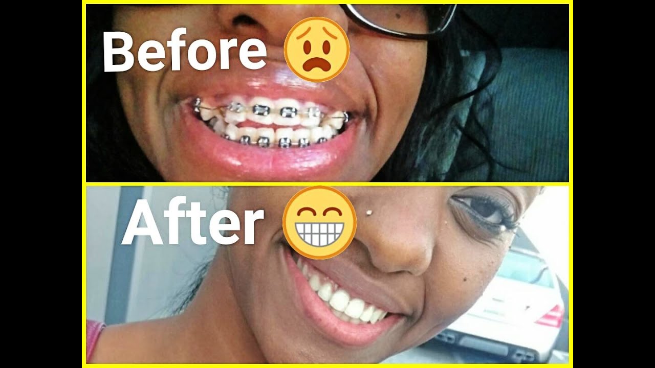 Cheap braces removal near me