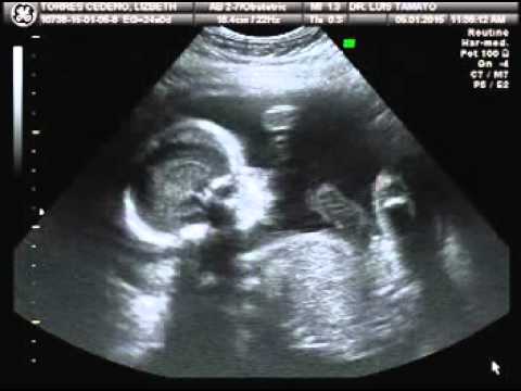 eco 24 semanas de gestacion - YouTube