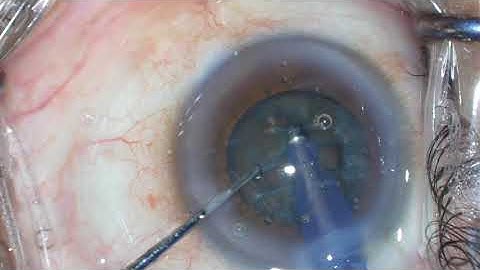 Phaco Divide and Conquer