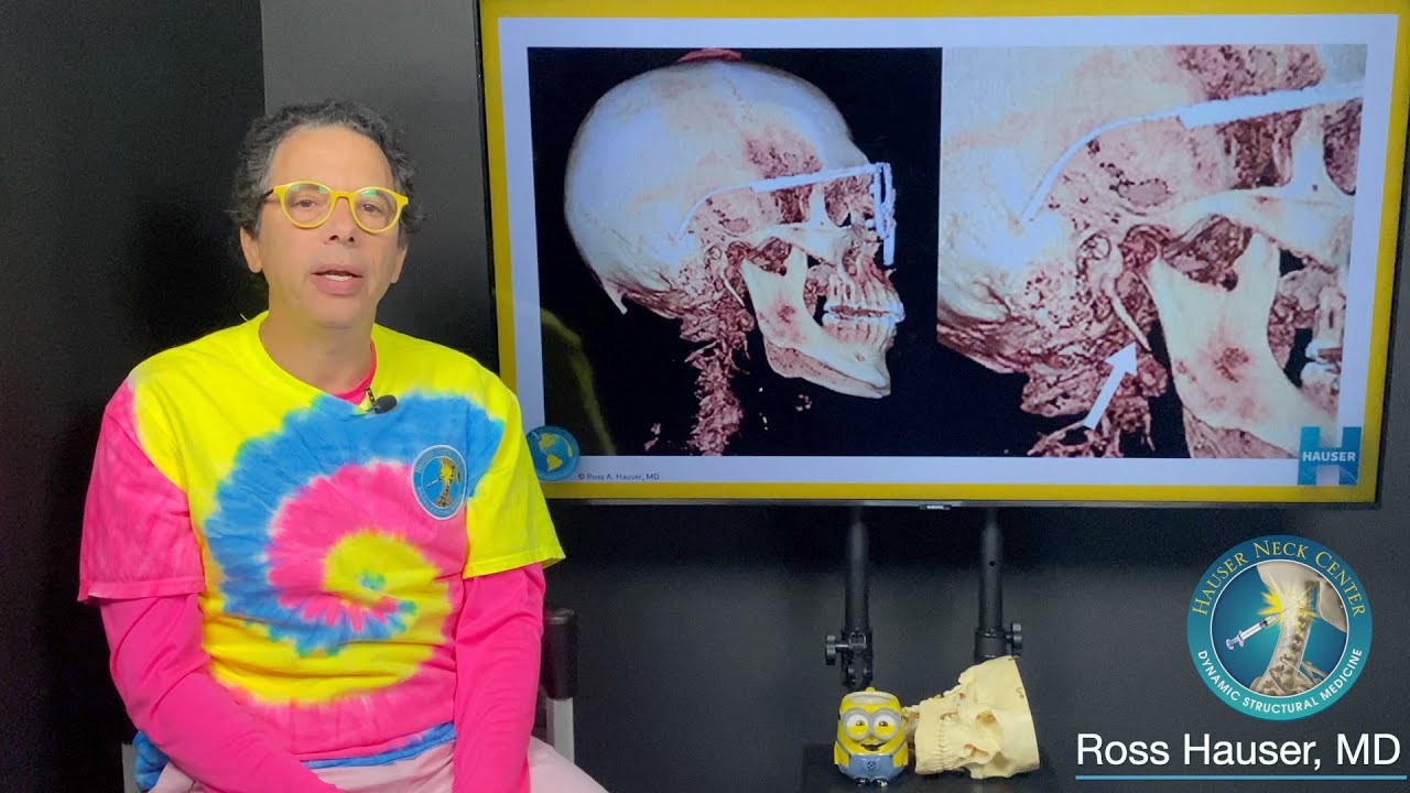 Cone beam CT scan showing elongated styloids, misalignments, and more. Hauser Neck Center