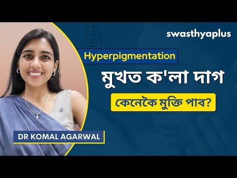 হাইপাৰপিগমেণ্টেচন: চিকিৎসা কি? | Hyperpigmentation/ Dark Patches, in Assamese | Dr Komal Agarwal