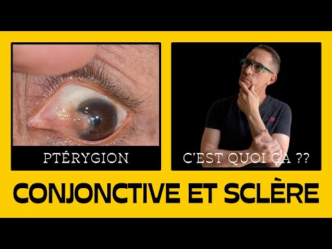 Vidéo: Devrais-je porter des lentilles en cas d'hémorragie sous-conjonctivale ?