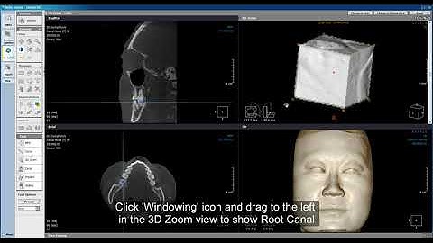 Xelis Dental Case Tutorial Segment Root Canal