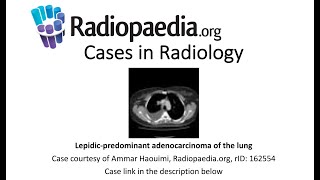 Lepidic-Predominant Adenocarcinoma Of The Lung Radiopaedia Cases In Radiology
