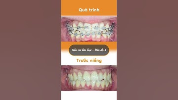 Hành trình LỘT XÁC nhờ niềng răng của Huyền Trâm