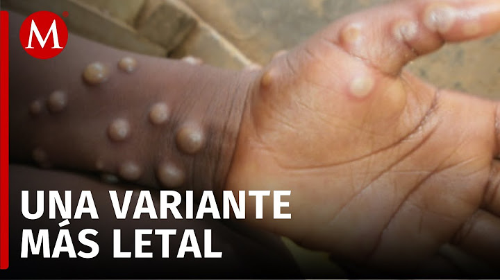 OMS declara emergencia sanitaria por viruela del mono; se expande nueva variante más letal