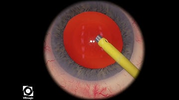 EyeSi CAT B Phaco Training, Level 3