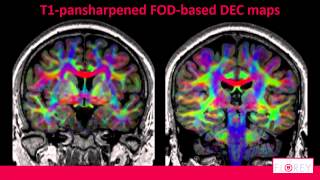 Celebrity Panchromatic sharpening of FOD-based DEC maps by structural T1 information Wealth