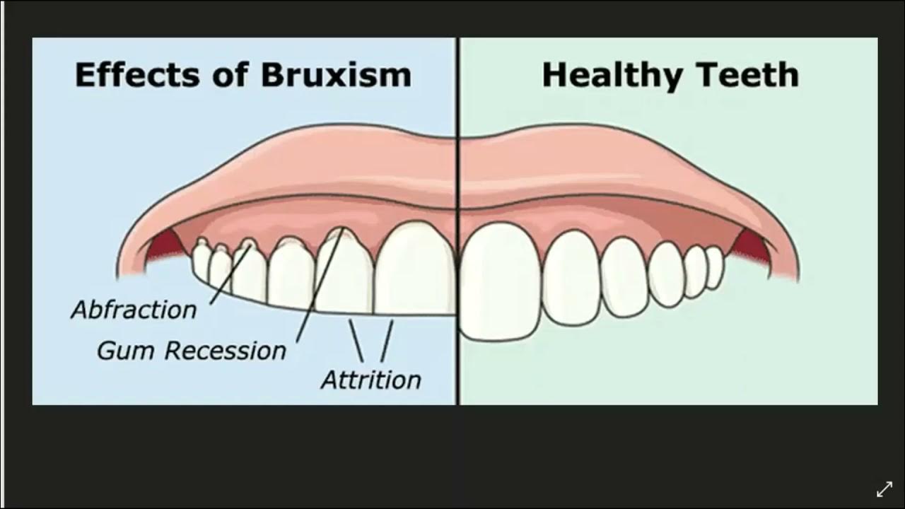 почему сводит зубы