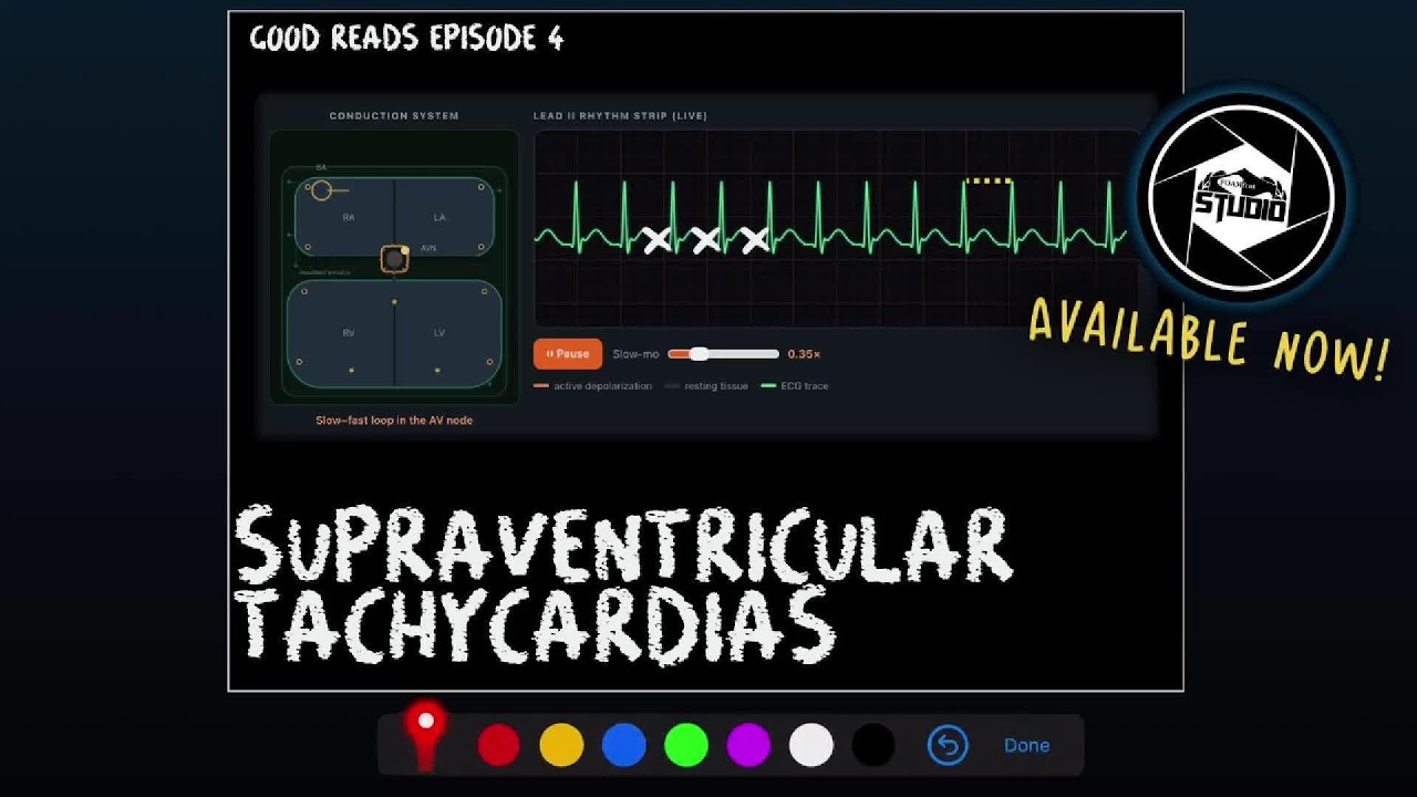 New FOAMfrat Studio Class - Supraventricular tachycardia (SVT)