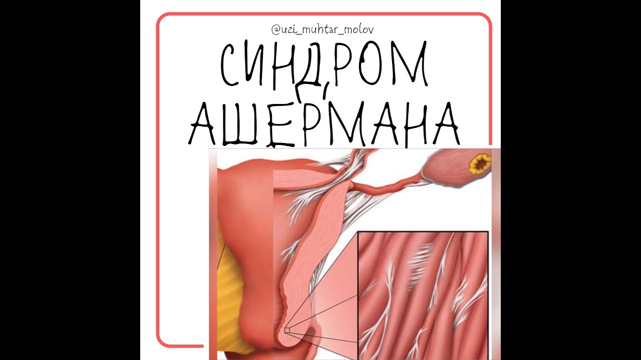 Синдром Ашермана - внутриматочные синехии, на УЗИ органов малого таза ...