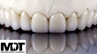 Contouring Ceramic Crowns - Step by Step Guide For The Perfect Smile Design