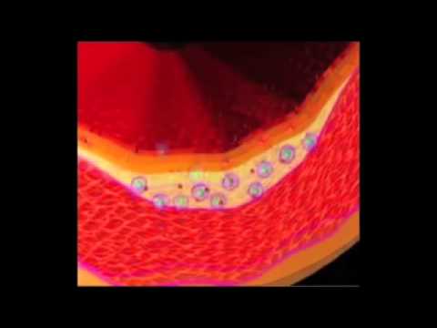 Vídeo: L'aterosclerosi és un ateroma?