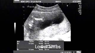 Pregnancy at 17 weeks.wmv